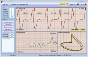 Theremino V1.0 ECG