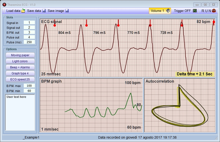 Ecg Chart Examples